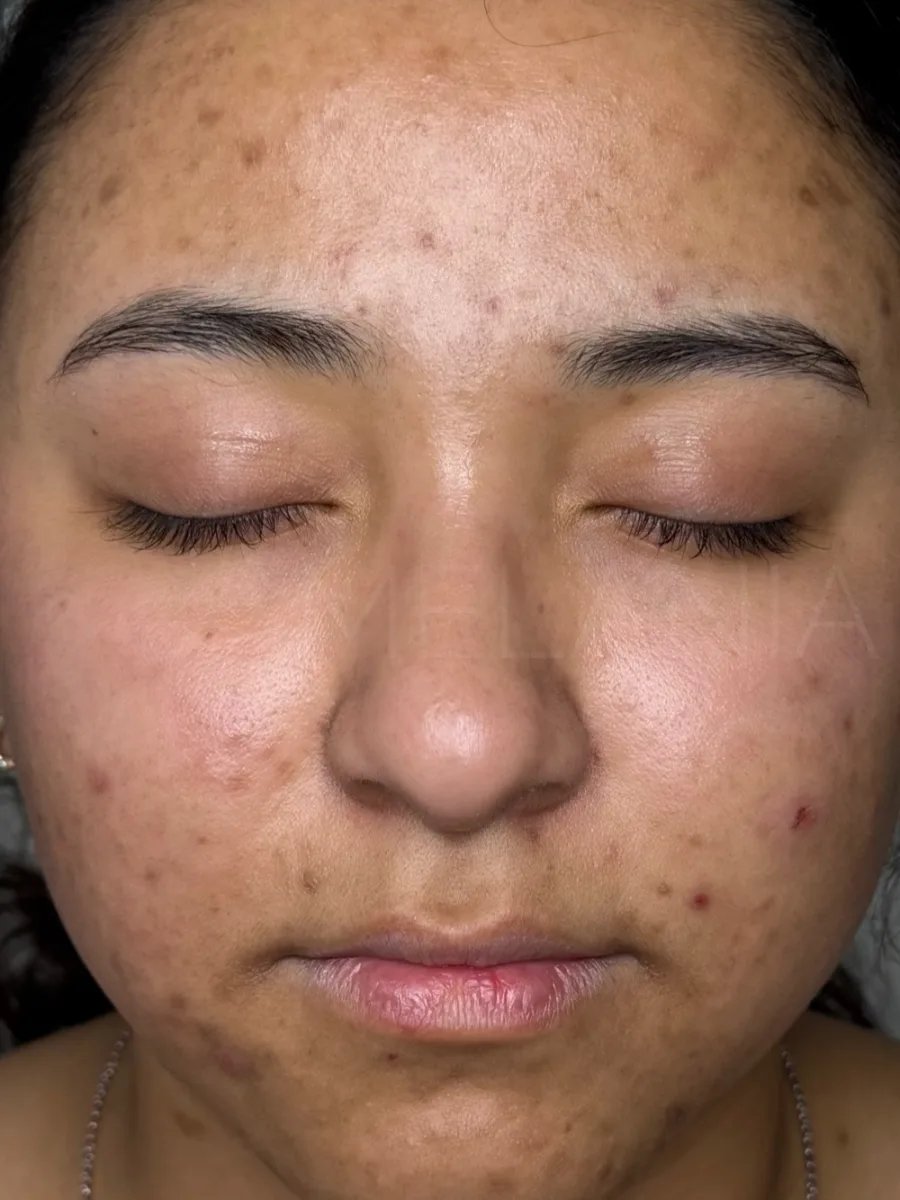 Antes: rostro de frente con pigmentación y marcas de acné