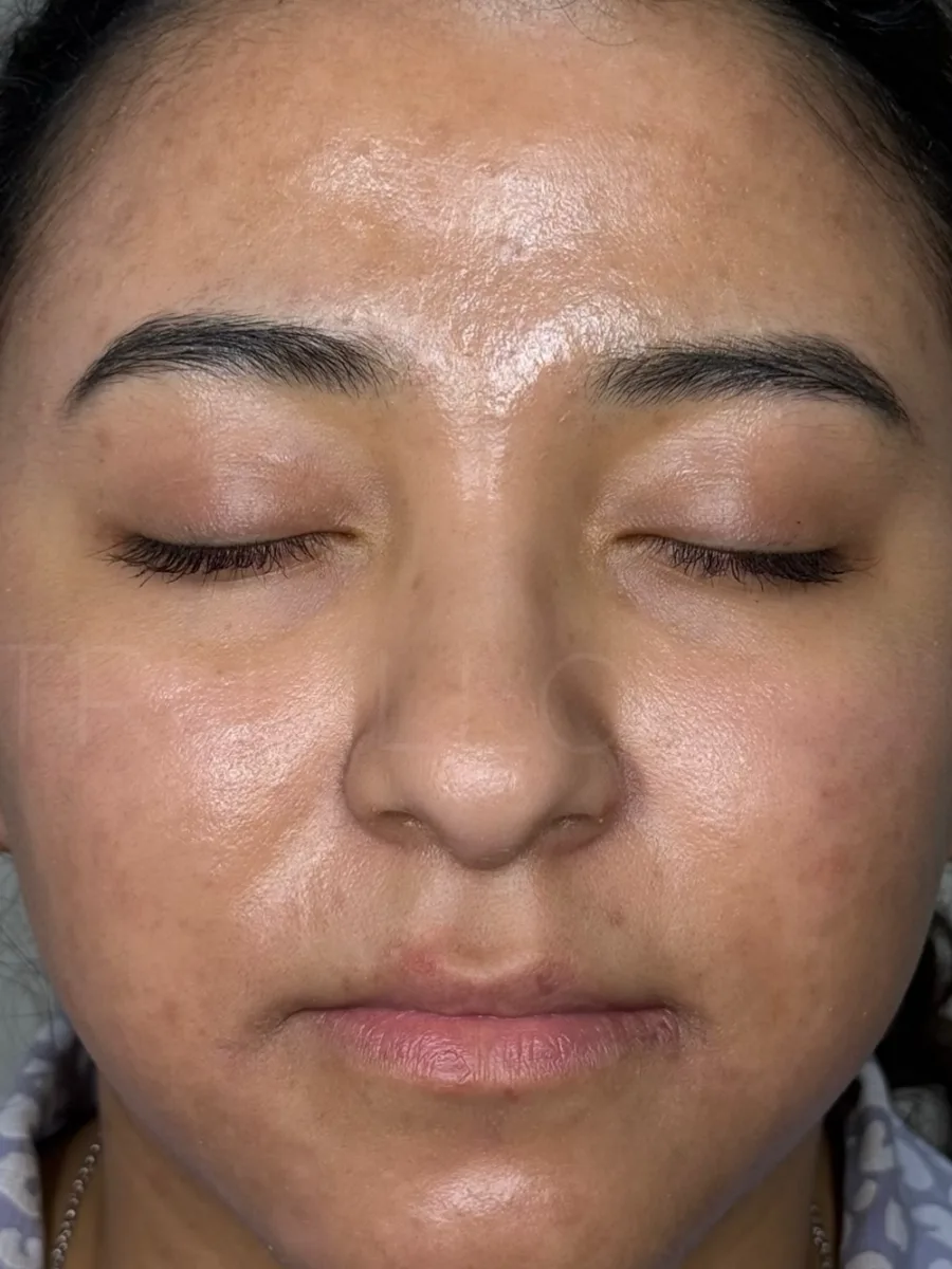 Después: rostro de frente con pigmentación y marcas de acné